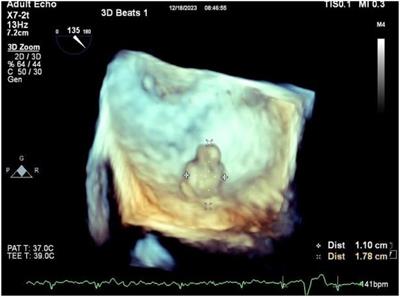 Complicated atrial myxoma with coro-cameral fistula arising from its feeding branch: a case report